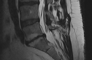 IRM lombaire en coupe sagittale montrant vertèbres, disques intervertébraux et plateaux vertébraux (contexte lombalgie et MODIC)